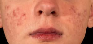 How to get it rid of blackheads
