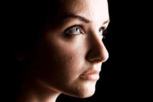 how to get rid of acne scars