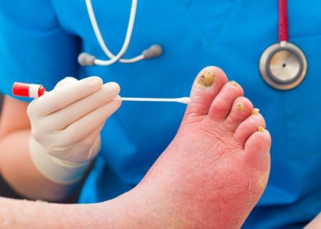 toenail infection treatment