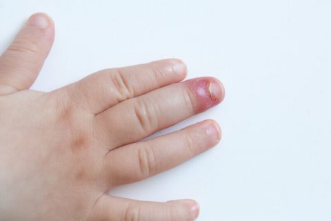 fingernail fungus