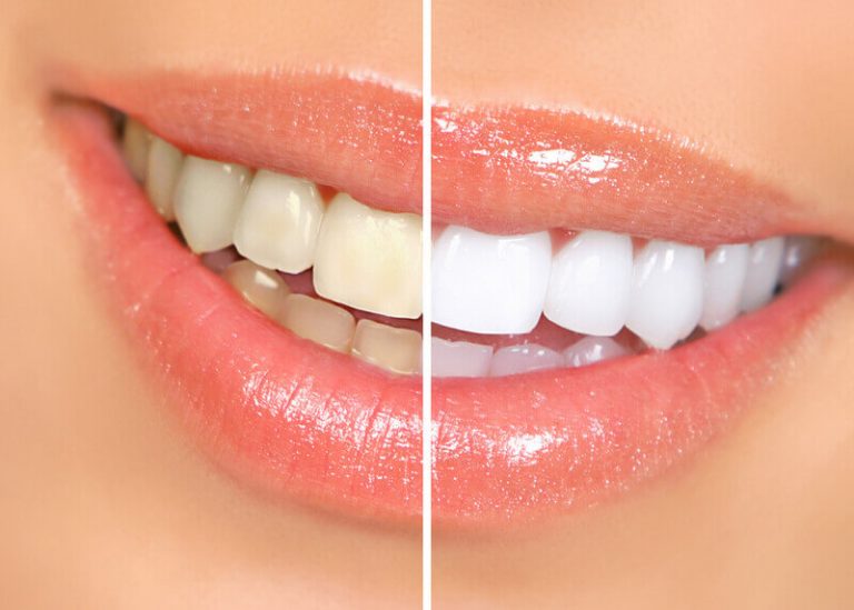How To Make Teeth Stronger And Healthy7 Tips That Helps