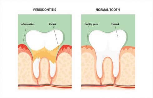 is periodontal disease reversible
