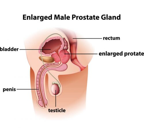 is enlarged prostate serious