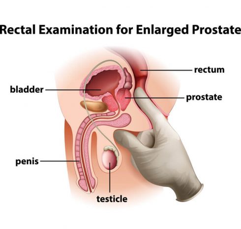 symptoms of enlarged prostate