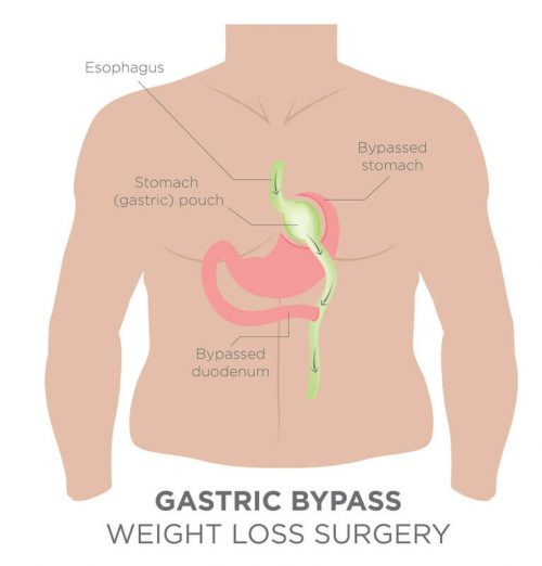 gastric bypass weight loss
